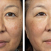 (Fractional + Ablation) Works effectively on Moles, Warts, Skin tags, Seborrheic Keratosis, Scar revision & Superficial Lesions, Skin- rejuvination (For Wrinckles & Pigmentation)