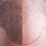 Permanent unwanted Hair Reduction from all body parts