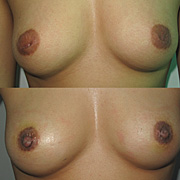 inverted nipples