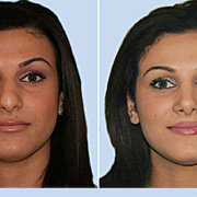 nose correction in nepal