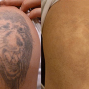 Tattoo removal, Freckles, Black or Blue Birth mark removal Nevus of Ota, Acne/Pore size minimize. Age spots, Lentigo