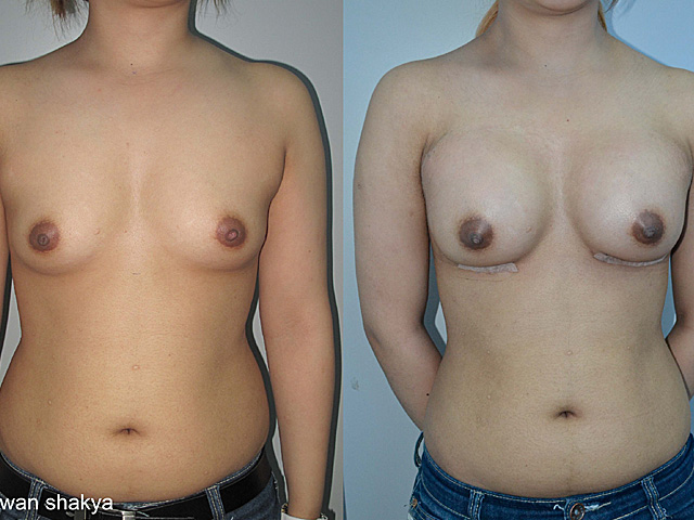 upper eye lid surgery