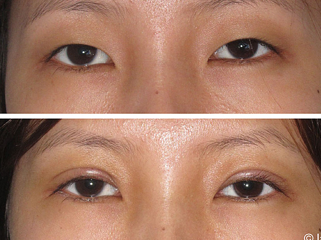 facial scar corretion