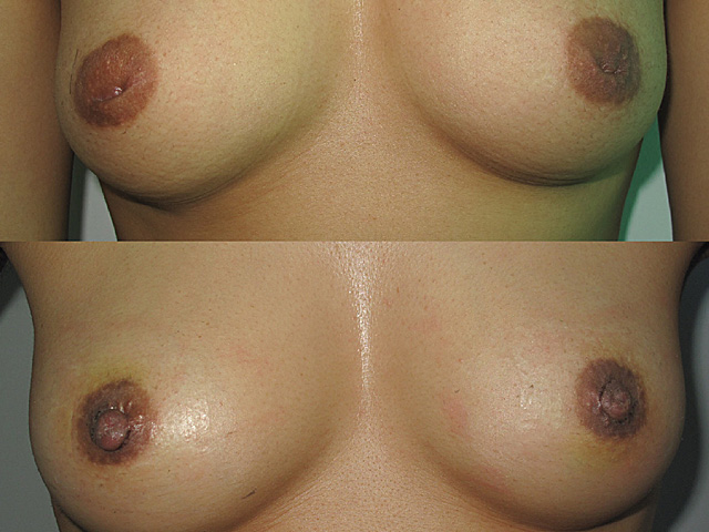 breast surgery