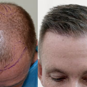 Permanent unwanted Hair Reduction from all body parts