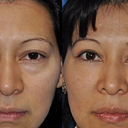 Hair Treatment Nepal